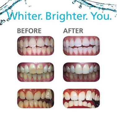 Teeth whitening reviews polanight