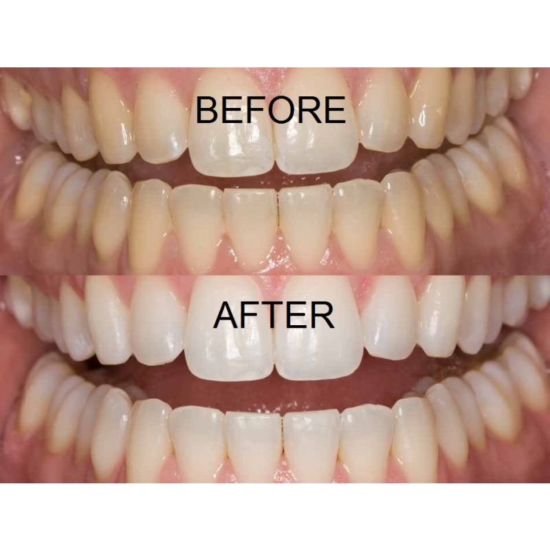 16 teeth whitening gel