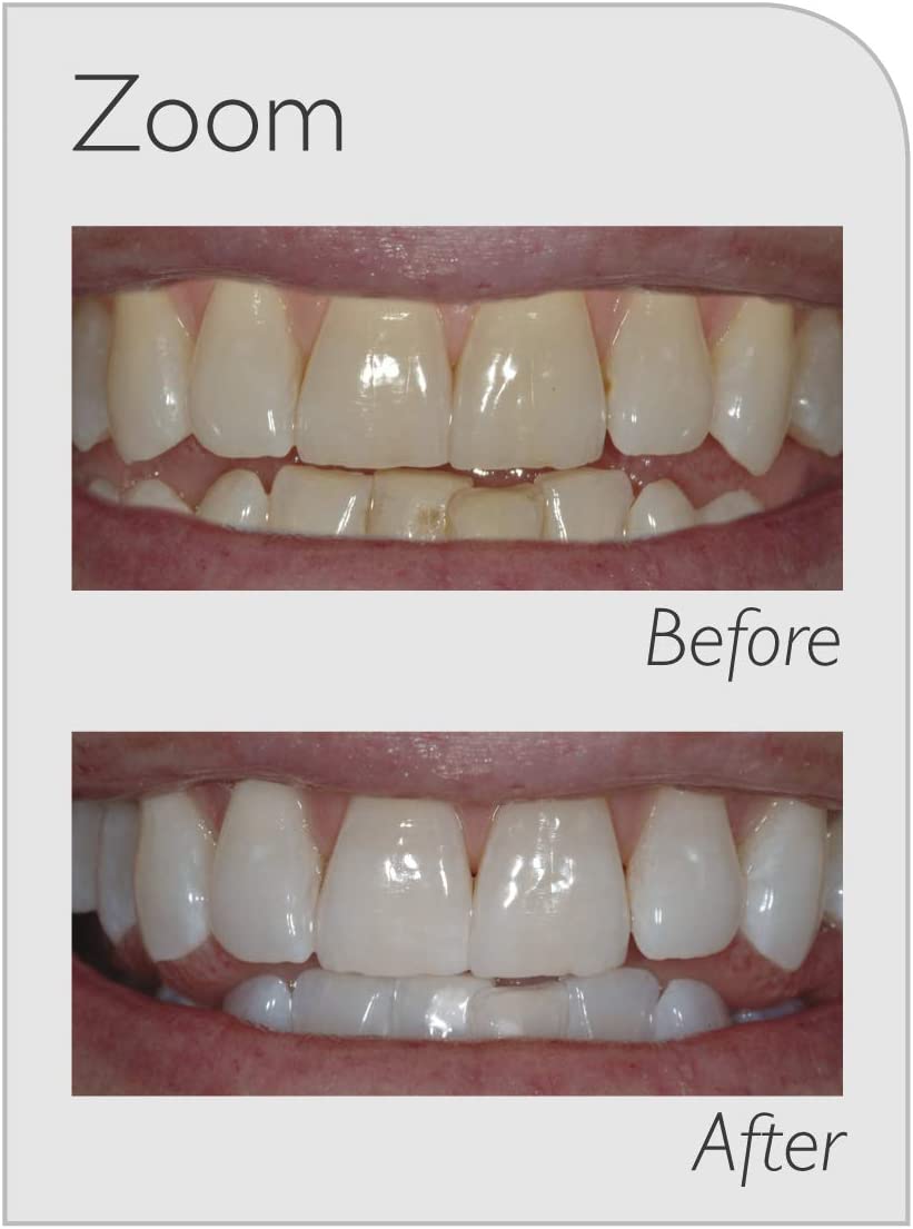 zoom teeth whitening pricing