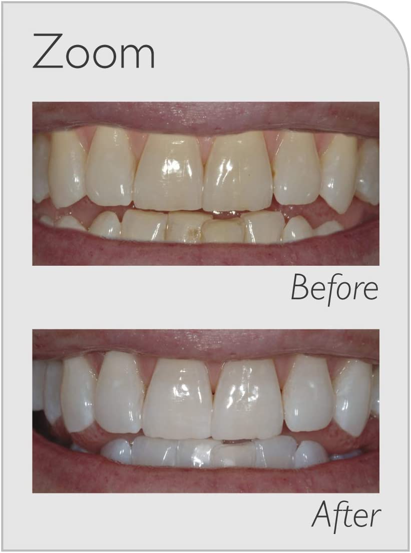 Philips Zoom 6% Day White Carbamide Peroxide Teeth ...